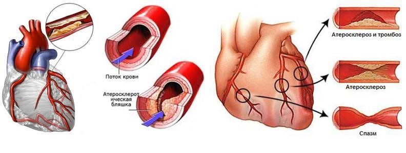 Абдоминальная форма инфаркта миокарда: симптомы, первая помощь и лечение