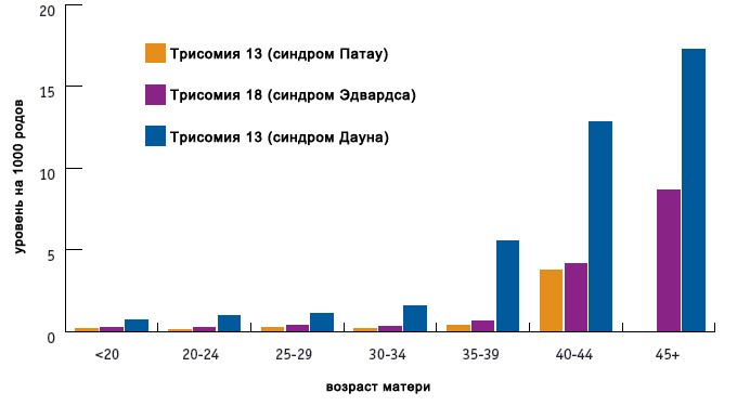 синдром эдвардса фото