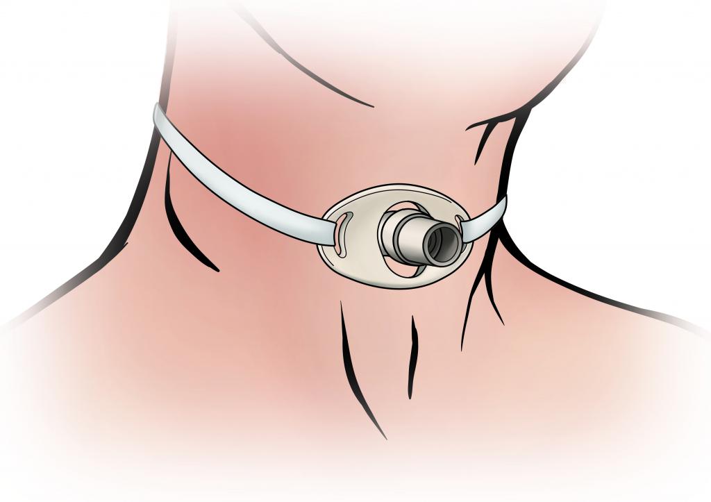 осложнения после трахеостомии