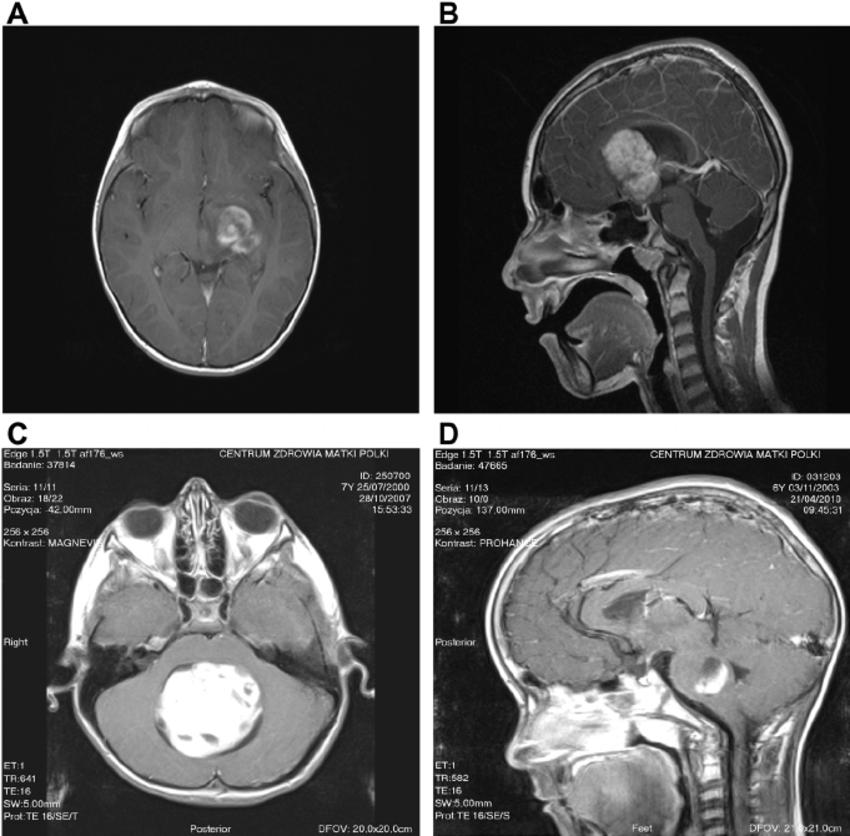 cerebellar tumor in children