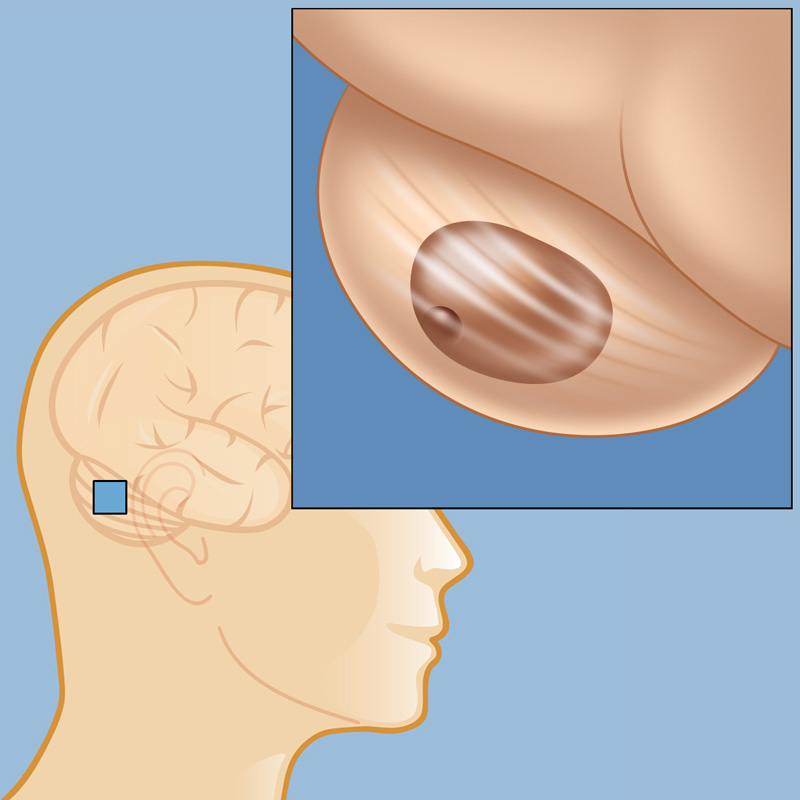 cerebellar tumor consequences