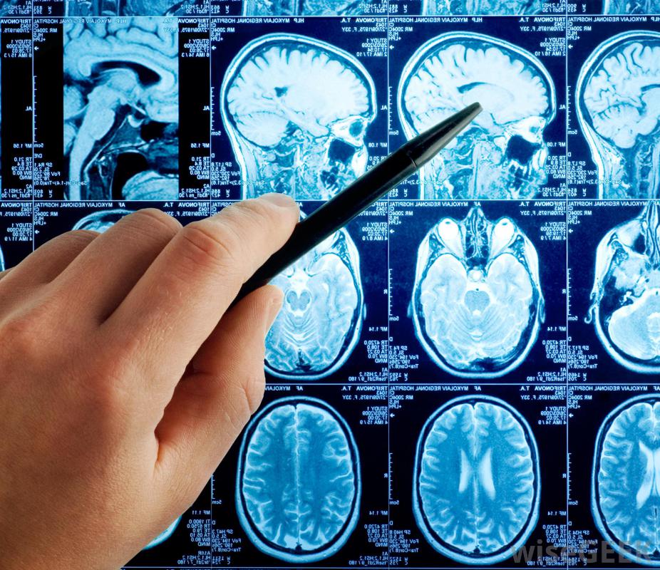 cerebellar tumor prognosis