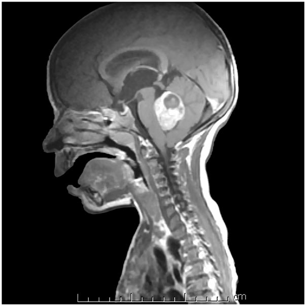 cerebellar tumor