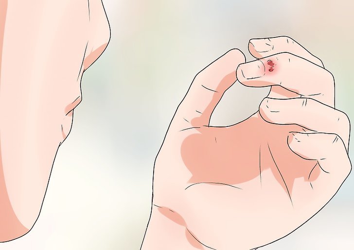 как лечить панариций на пальце у ребенка