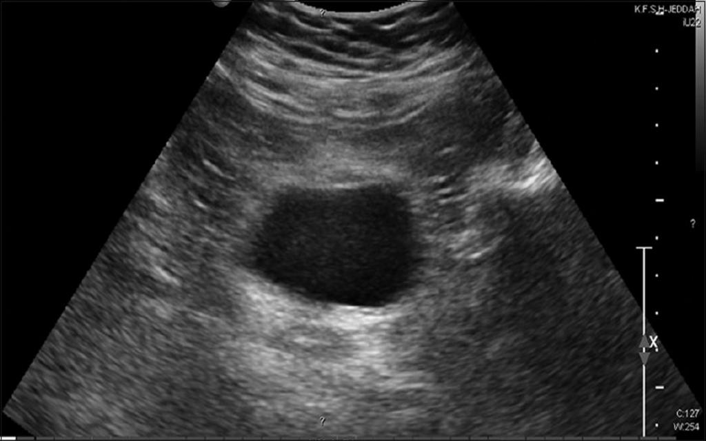 pelvic ultrasound in women with menstruation