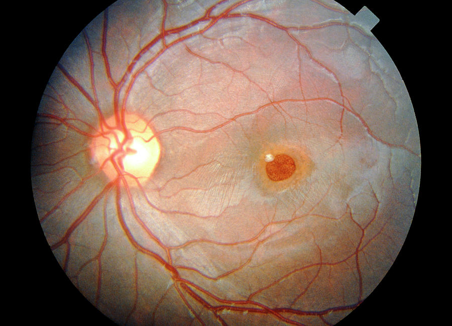 Офтальмоскопия глазного дна: виды, показания, как проводится