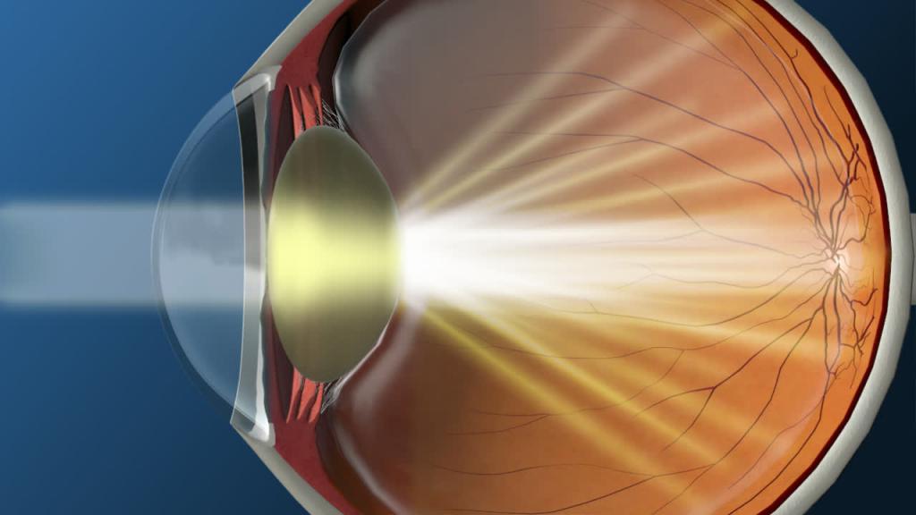 операция по удалению катаракты с заменой хрусталика