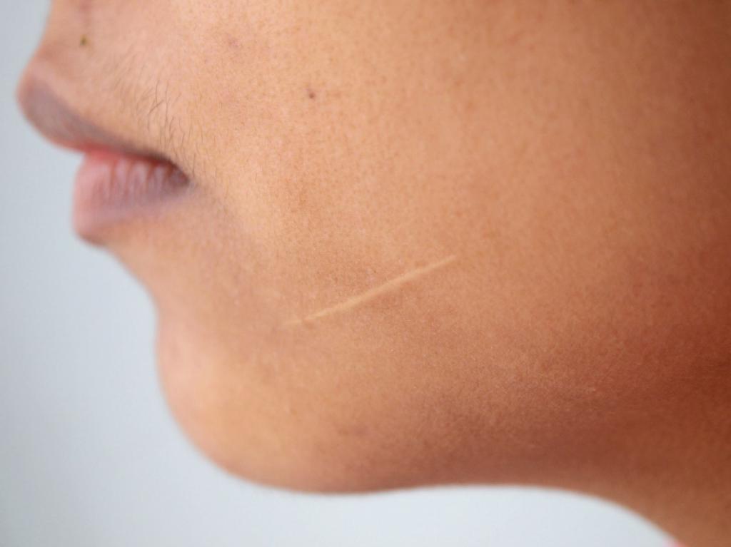 Как избавиться от шрамов на лице
