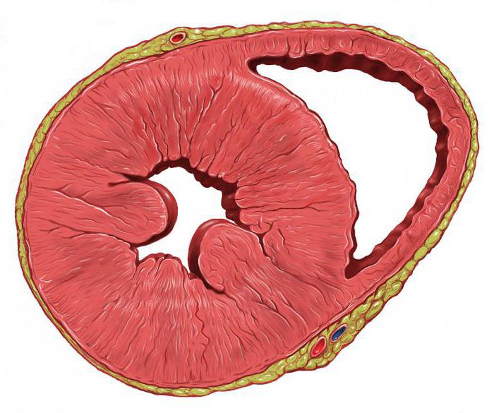 гипертрофия левого желудочка сердца можно лечить