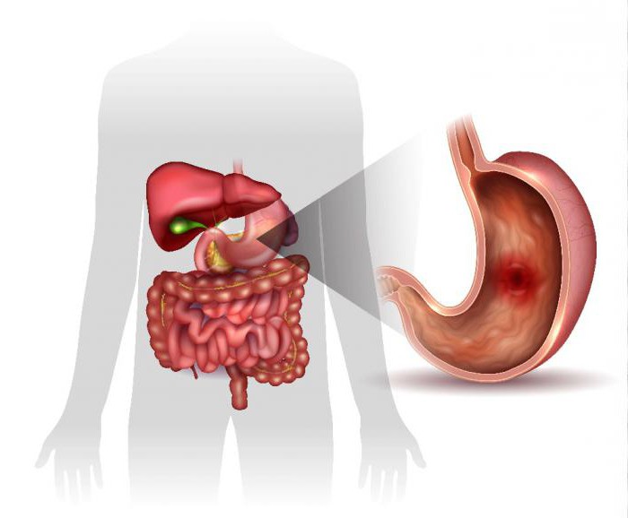 диагностика язвенной болезни желудка и двенадцатиперстной