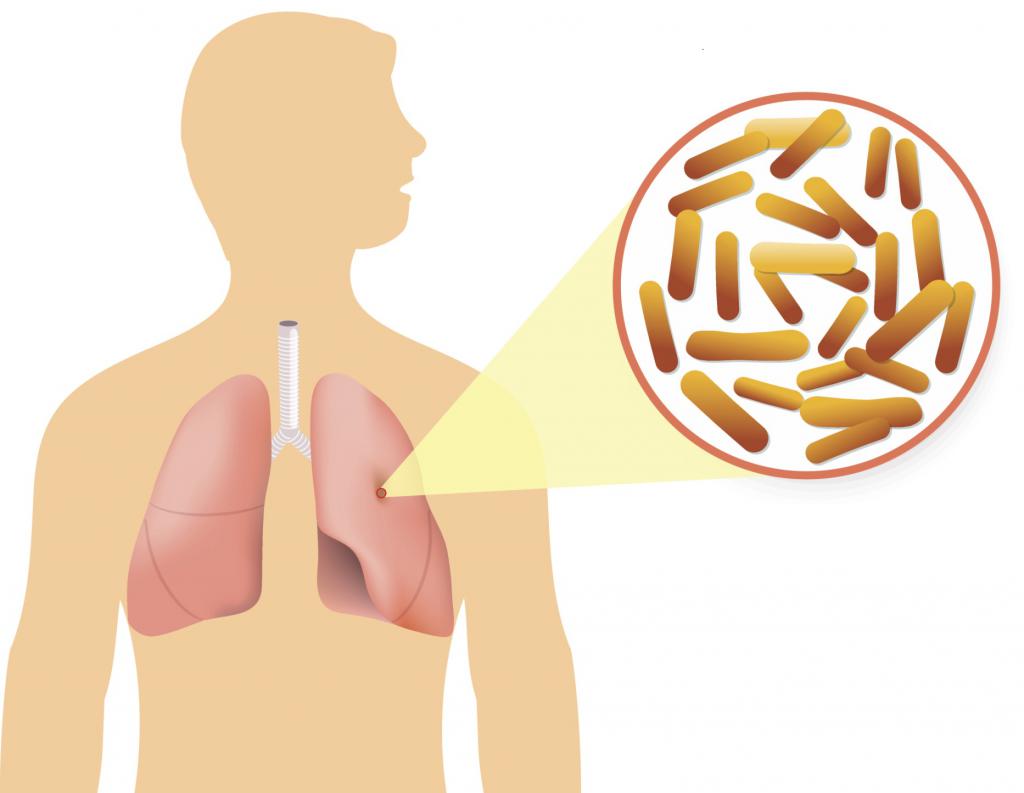 признаки туберкулеза легких
