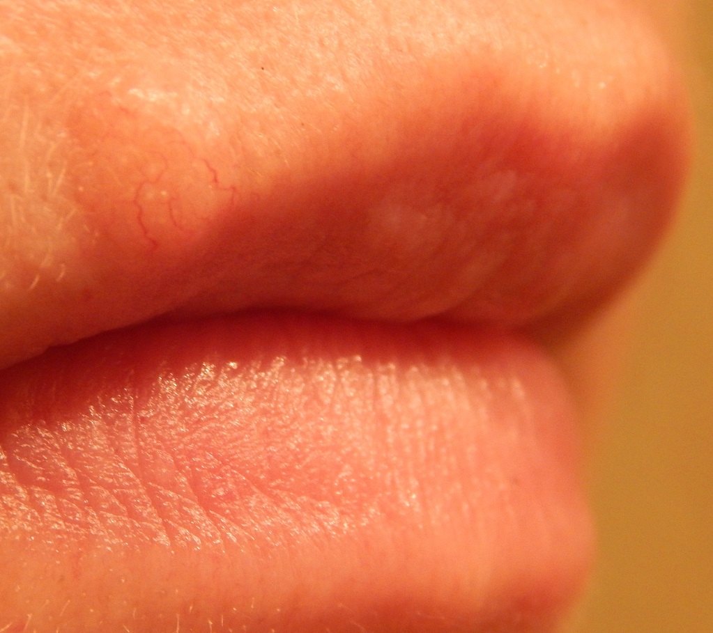 Базалиома кожи верхней губы