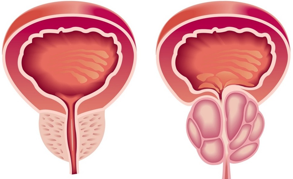 treatment of prostate adenoma with soda