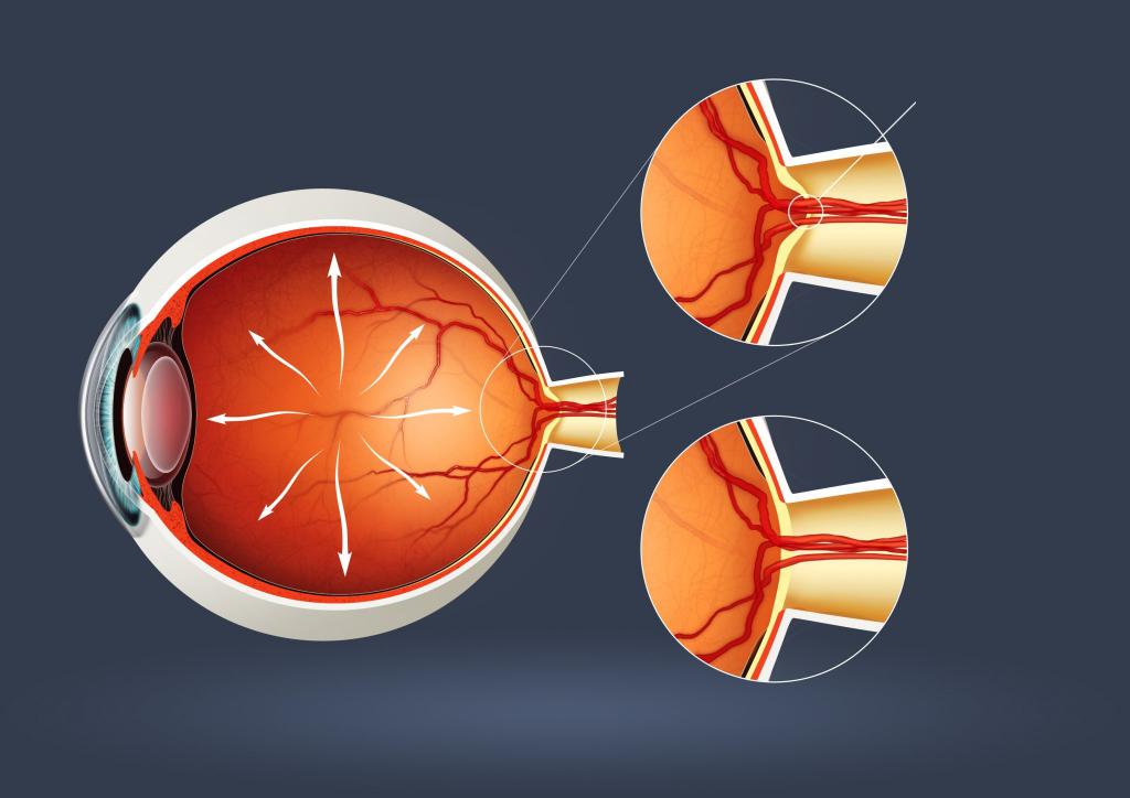 признаки глаукомы глаза симптомы