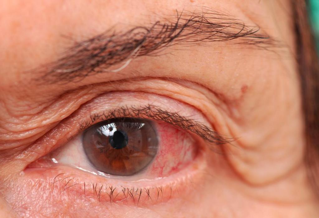 болезнь глаукома симптомы