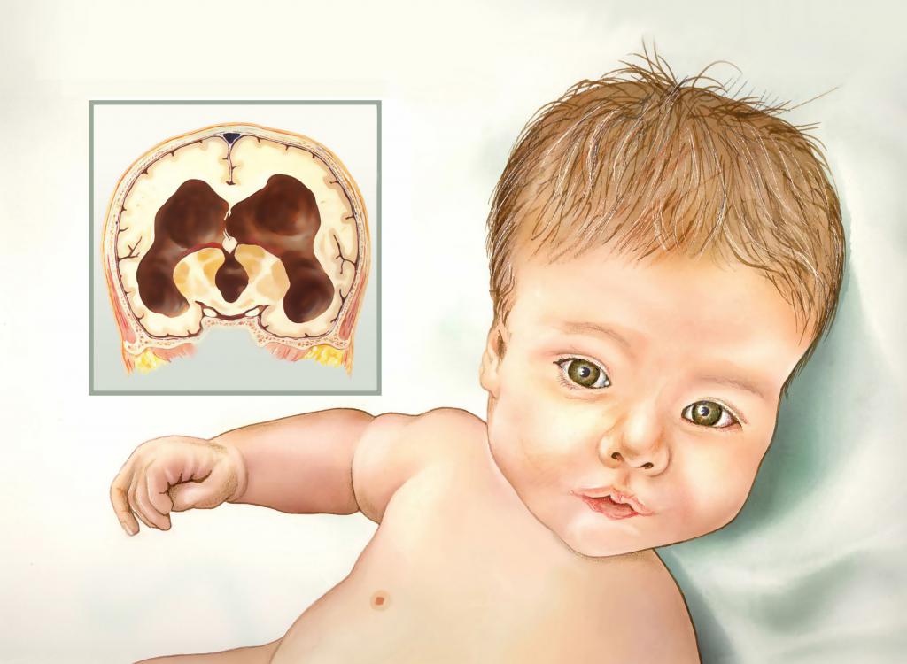гидроцефалия головного мозга у новорожденных