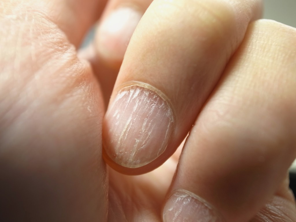 ногти болезни по ногтям фото