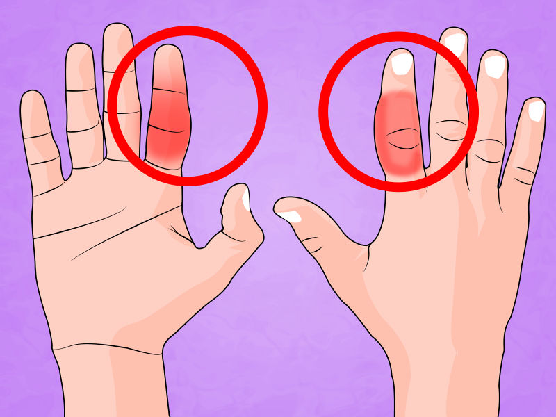 перелом пальца на руке симптомы