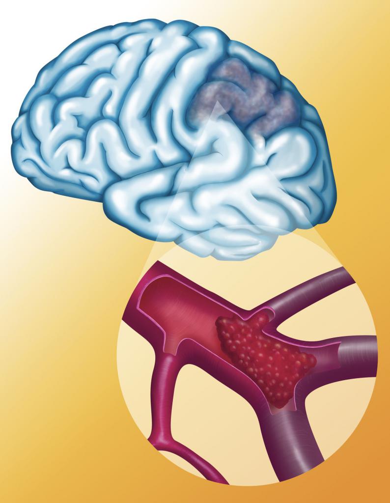 ишемия сосудов головного мозга лечение народными средствами