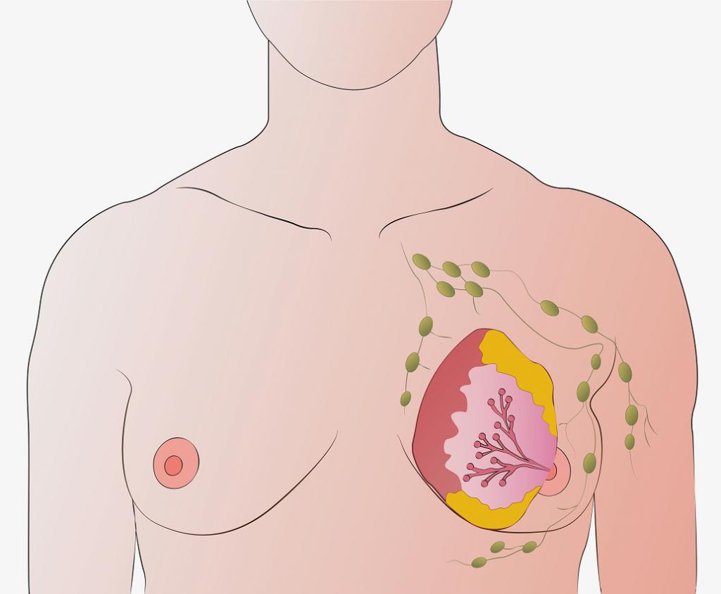 лимфатические узлы груди у женщин фото 61