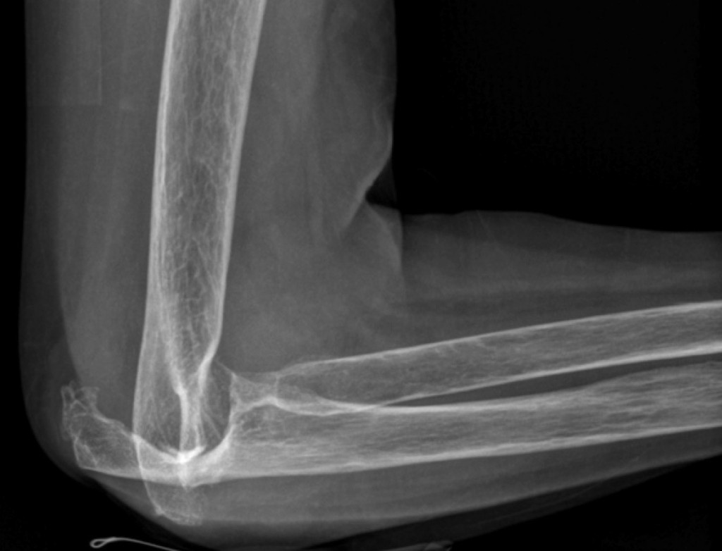 Посттравматический артроз локтевого сустава рентген