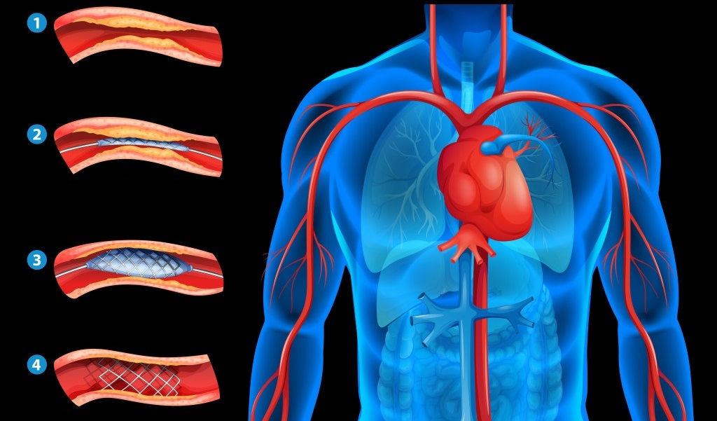 heart stenting surgery