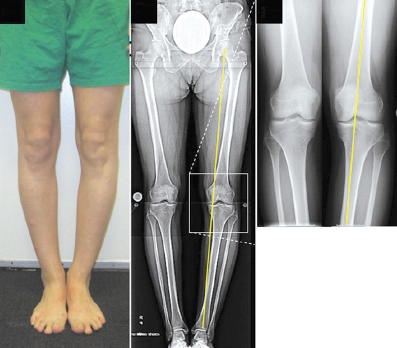 артроз коленного сустава рентген