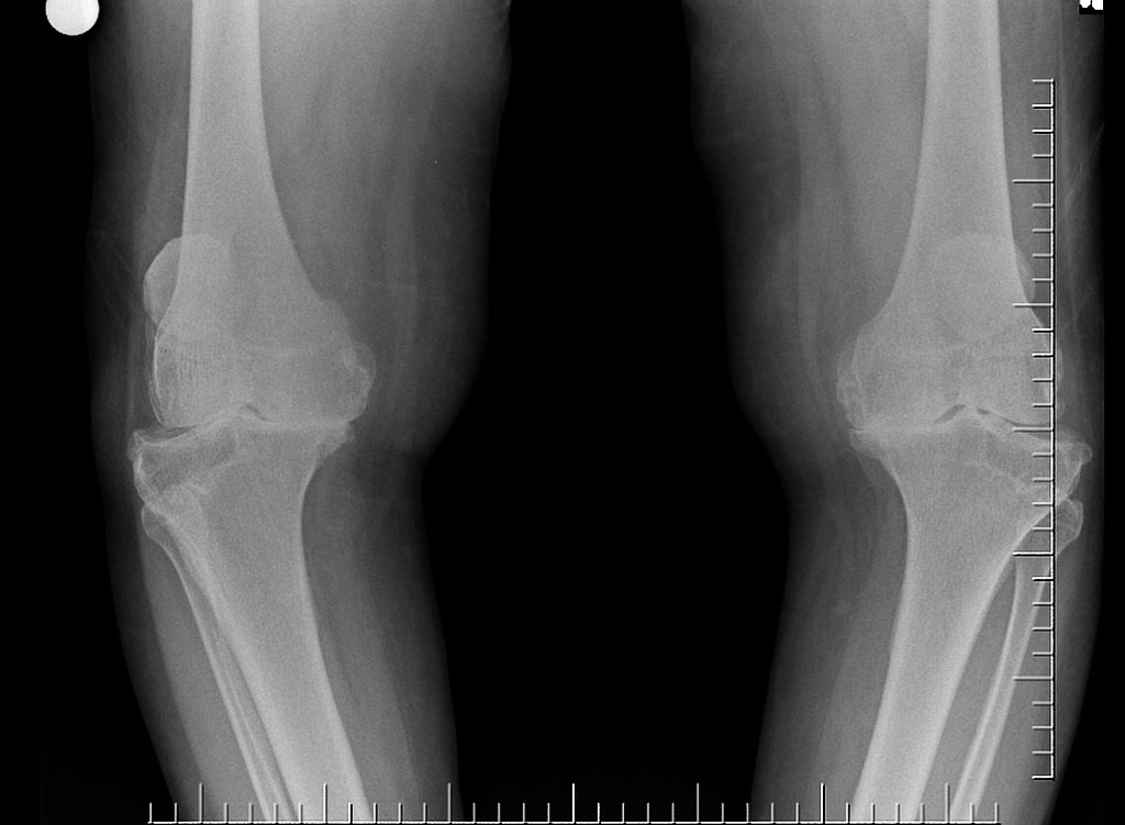 сделать рентген коленного сустава