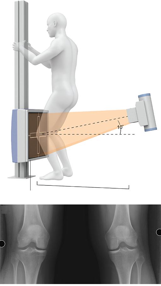 рентген коленного сустава двух