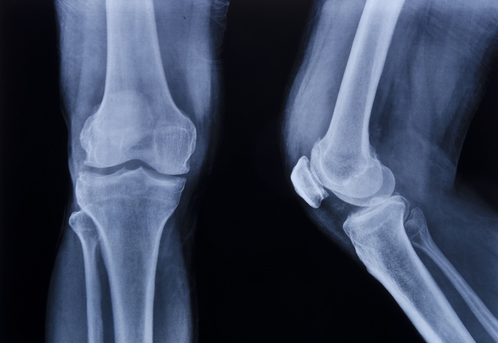 рентген коленного сустава проекциях