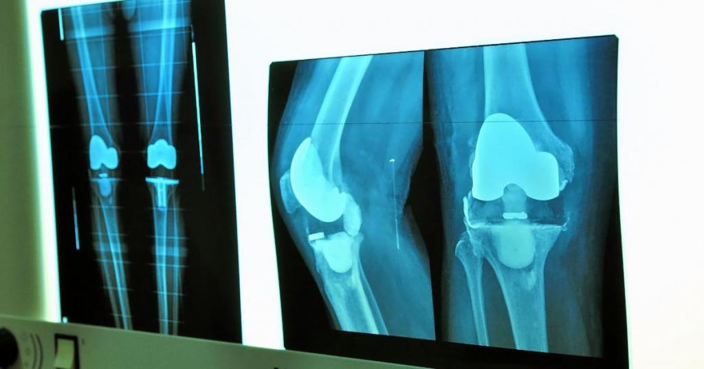 рентген коленного сустава показывает