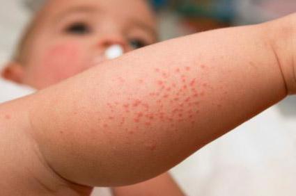 Мокнущий дерматит лечение у детей фото thumbnail