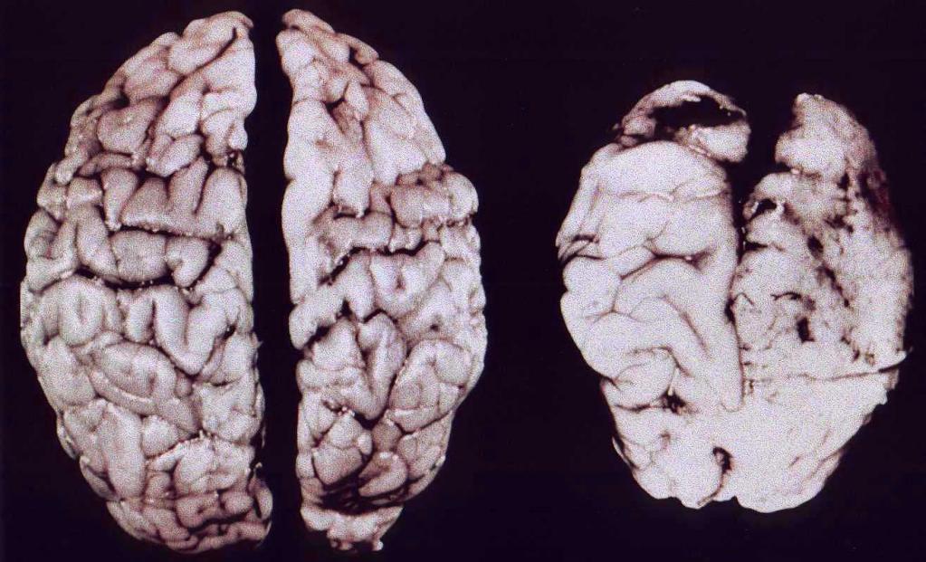 как влияет наркотик на мозг