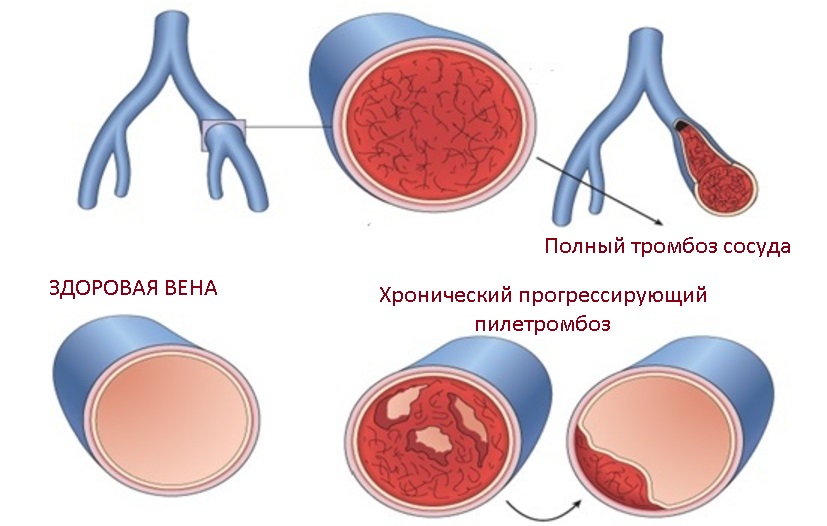 Тромбоз вен печени. Артериальный и венозный тромб. Артериальная и венозная тромбоэмболия.