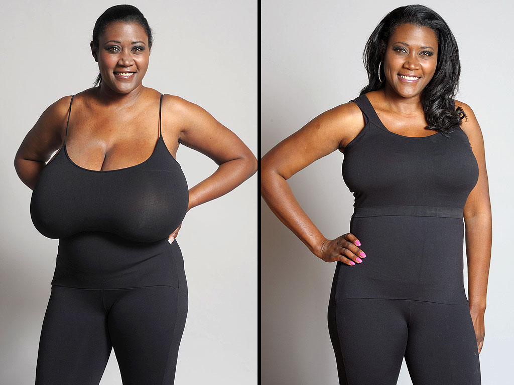 Операция по уменьшению груди фото до и после