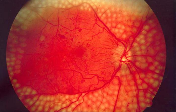 ангиосклероз сетчатки глаза что это такое