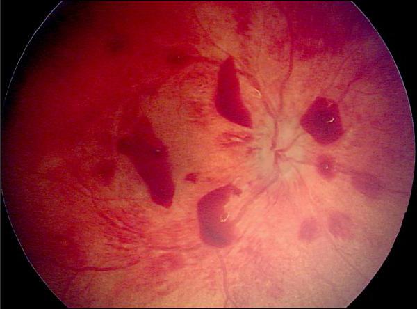 ангиосклероз сетчатки обоих глаз