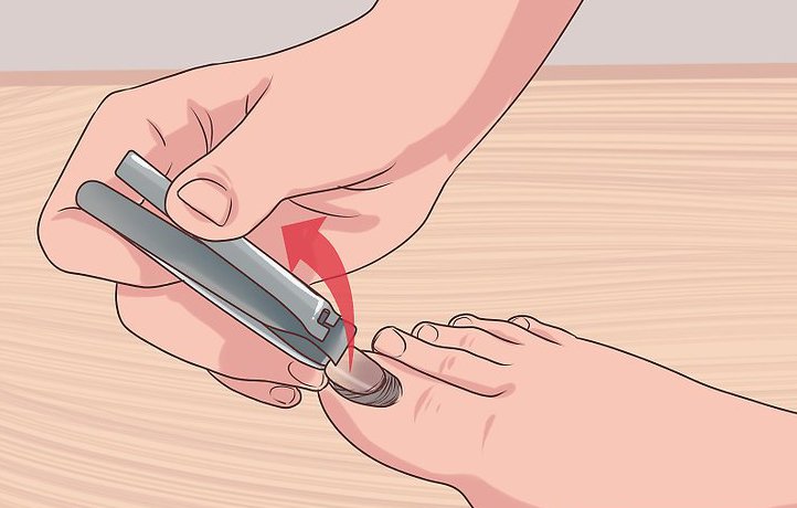 Как выдавить гной из пальца на ноге 25