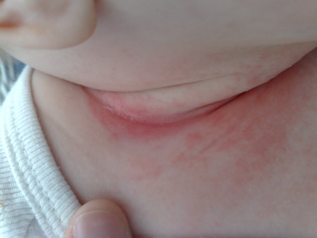 Diaper rash on the neck of a baby photo