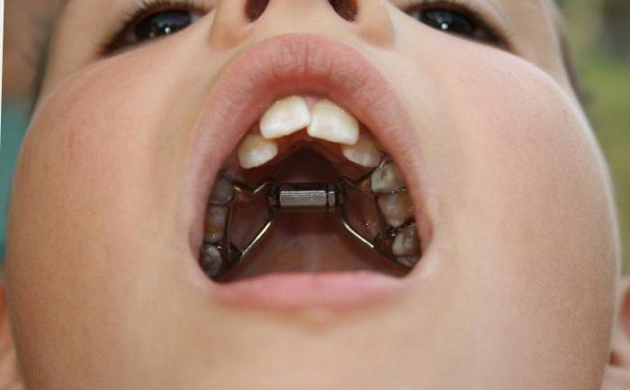 молочные зубы неправильный прикус
