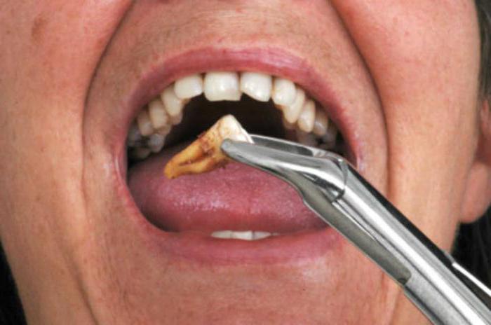Альвеолит после удаления зуба симптомы фото