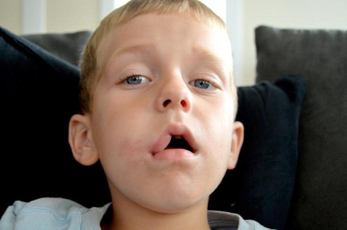 аллергия на лидокаин у ребёнка