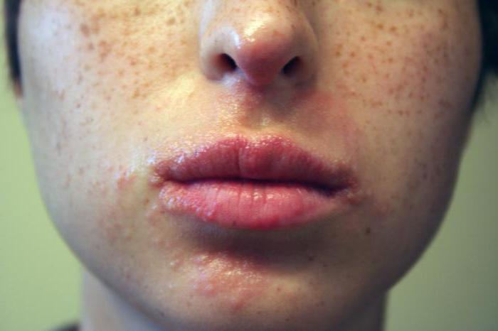 Аллергия на солнце симптомы лечение фото лицо thumbnail