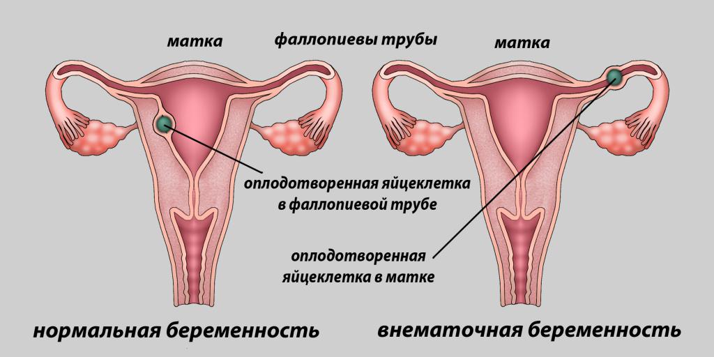 что такое внематочная беременность