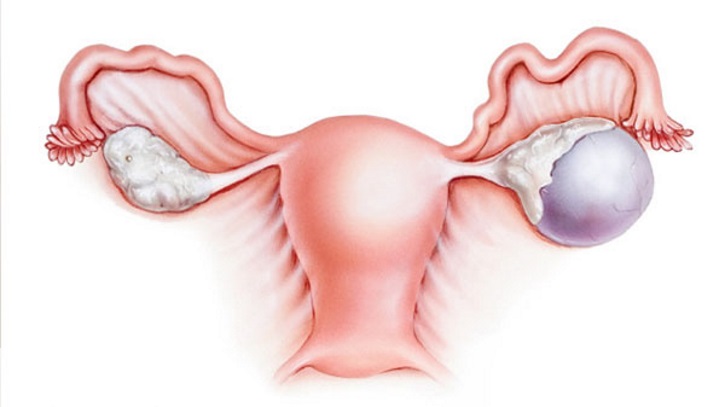 Ovarian cysts in menopause treatment