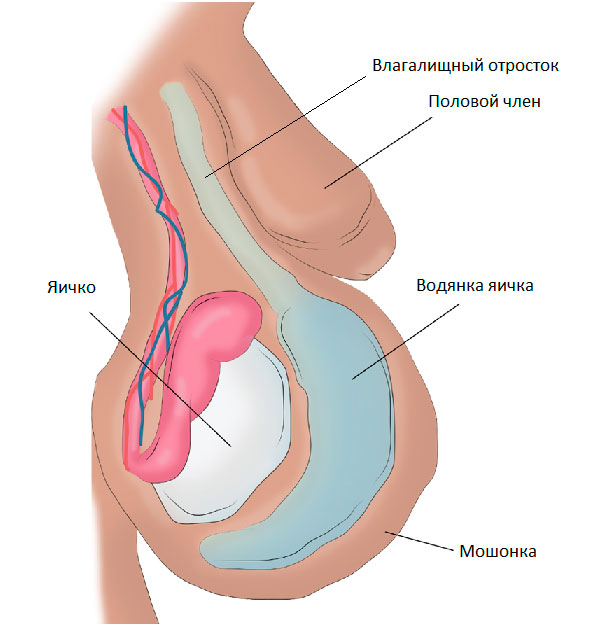 операция росса при водянке яичка у детей