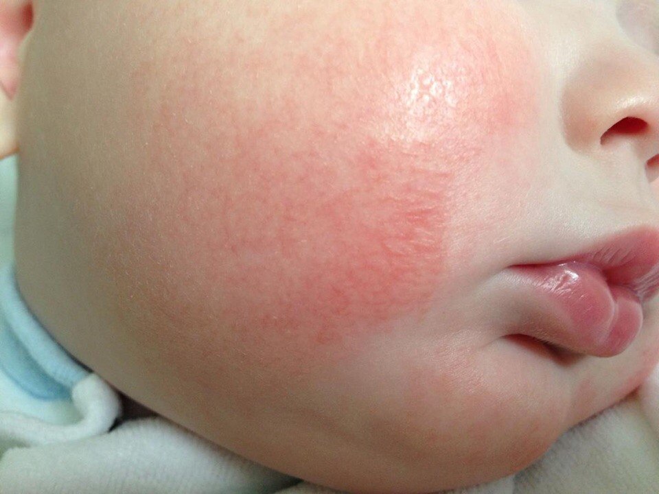 атопический дерматит у младенцев фото