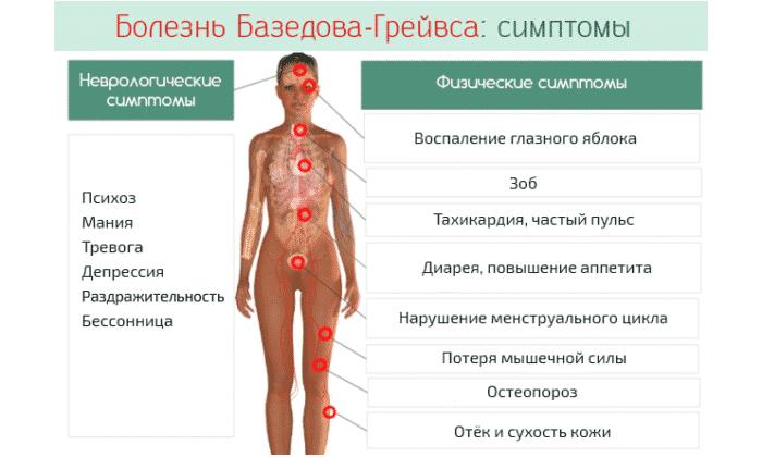 базедова болезнь