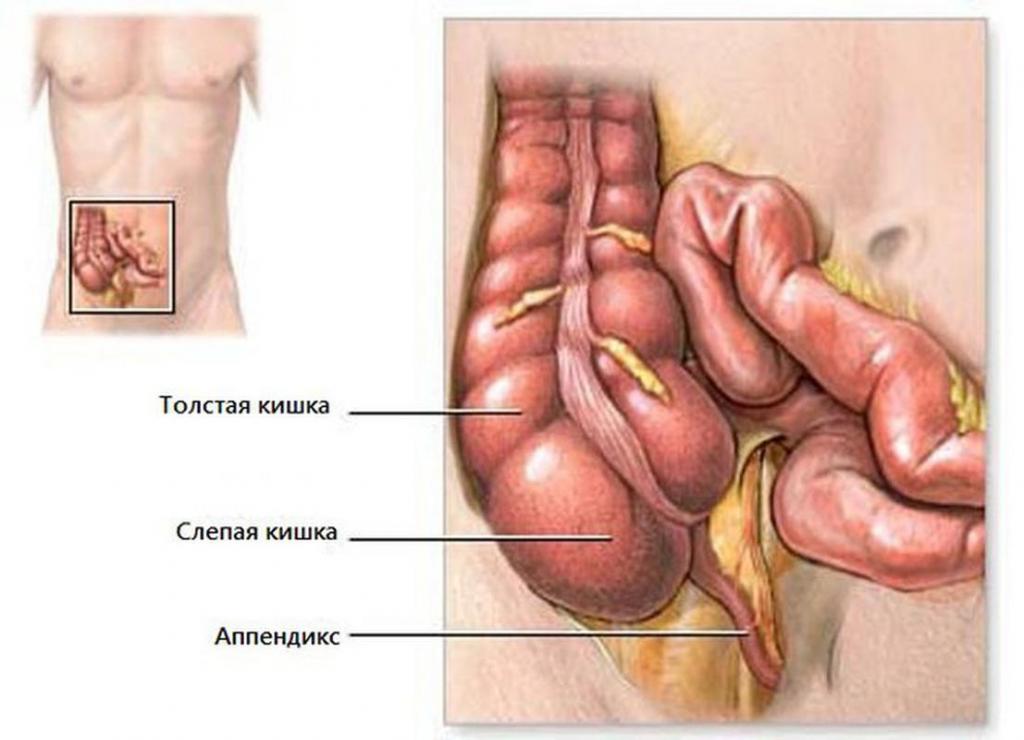 аппендицит неотложная помощь