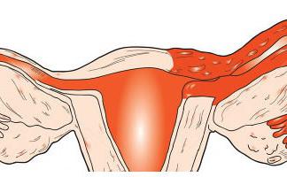 Воспаление труб у женщин 16